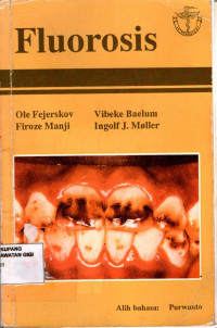 Image of Fluorosis = Dental fluorosis