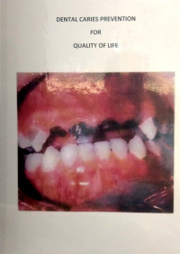 Image of Dental caries prevention for quality of life