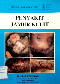 Image of Penyakit Jamur kulit